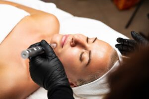 Microneedling for scars