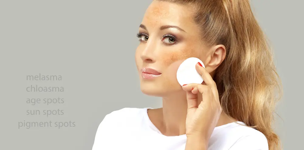 Chemical peel for Melasma