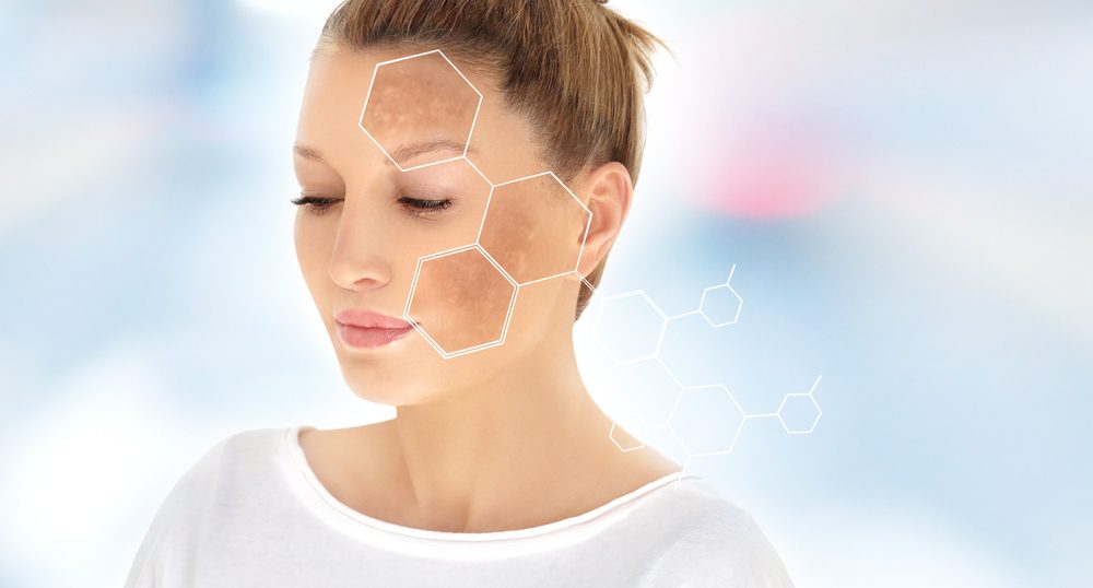 Chemical peel for Melasma