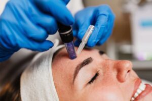 microneedling for scars in florida