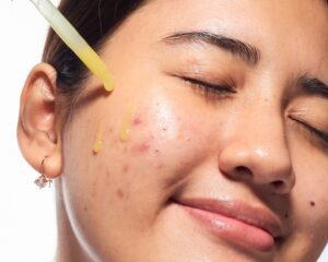 Chemical peel for acne scars